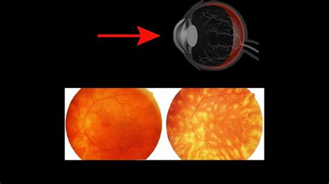 birdshot chorioretinopathy and diet.